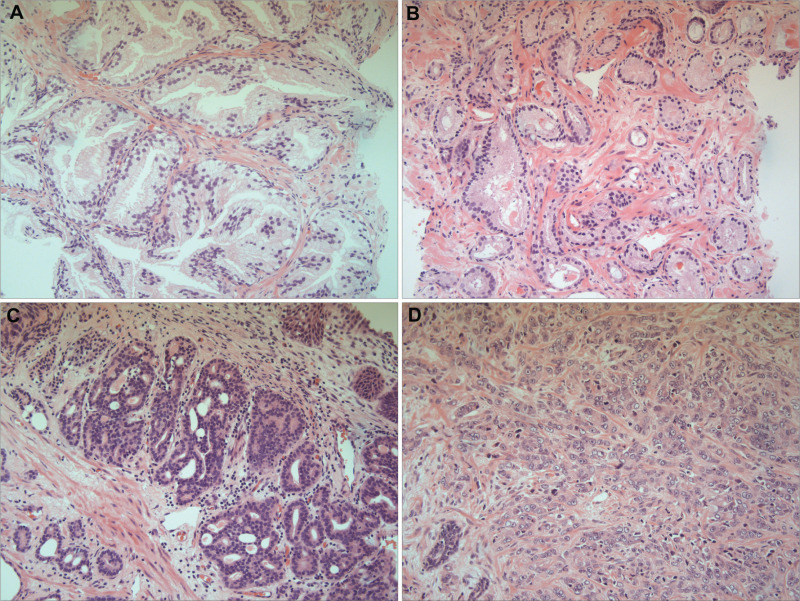 Real H and E prostate histology panels showing normal glands and Gleason patterns 3, 4 and 5