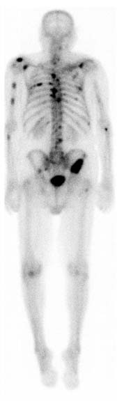 Bone scan showing osseous metastases from prostate cancer