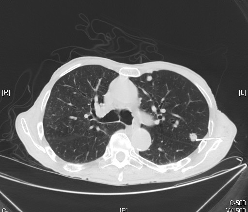 CT scan showing metastatic prostatic adenocarcinoma in the lung