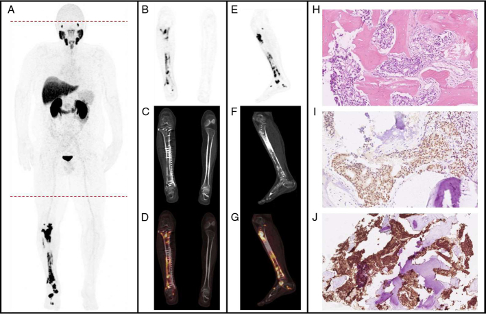 PSMA PET CT and pathology panels from prostate cancer osseous metastasis with pathologic tibial fracture