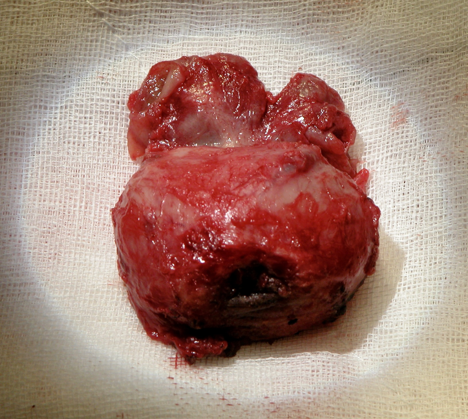 Removed prostate specimen on gauze