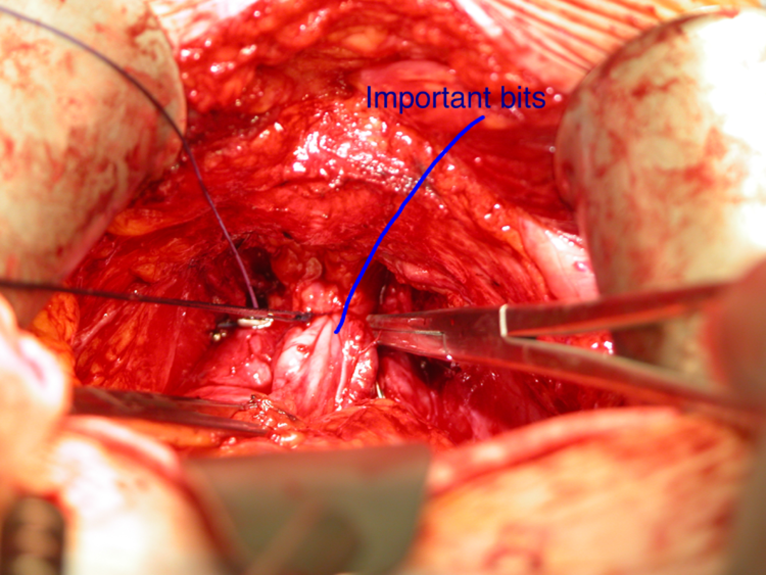 Intraoperative open prostatectomy field with careful dissection