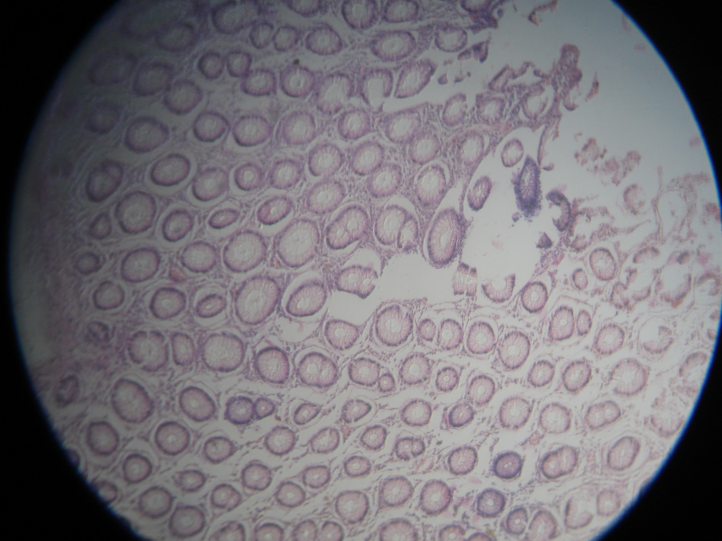 Colon adenocarcinoma histology
