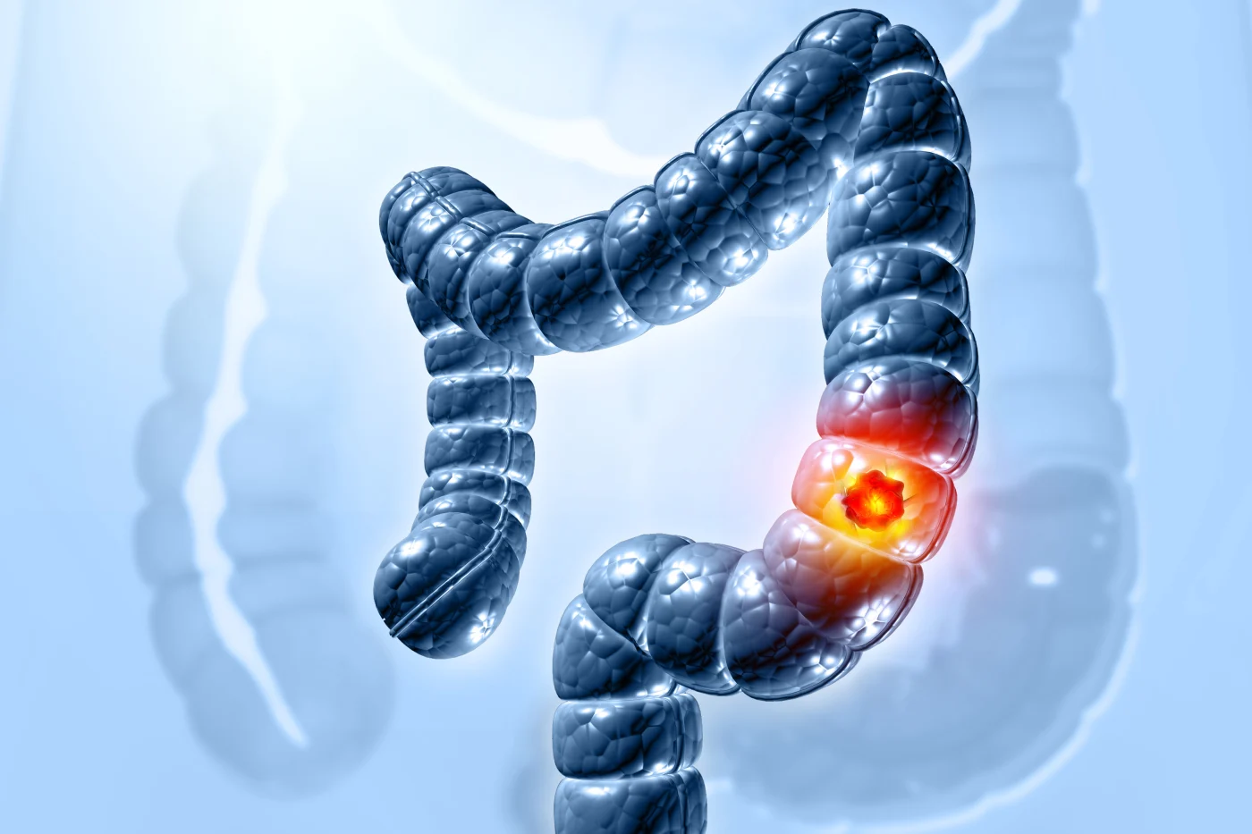 Medical illustration of colon cancer in the bowel