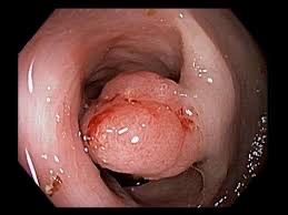 Colonoscopy image showing an abnormal bowel lesion