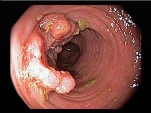 Colonoscopy view showing bowel polyps