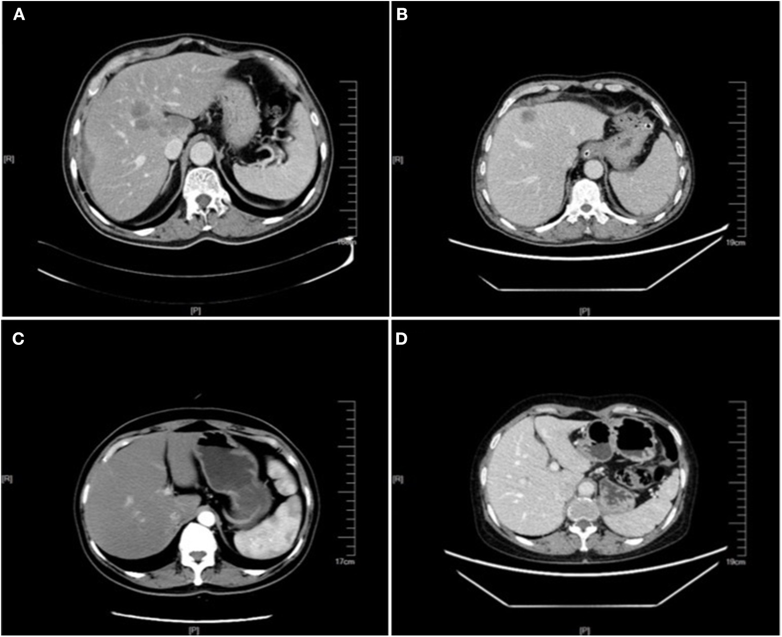 CT scan showing colorectal liver metastases