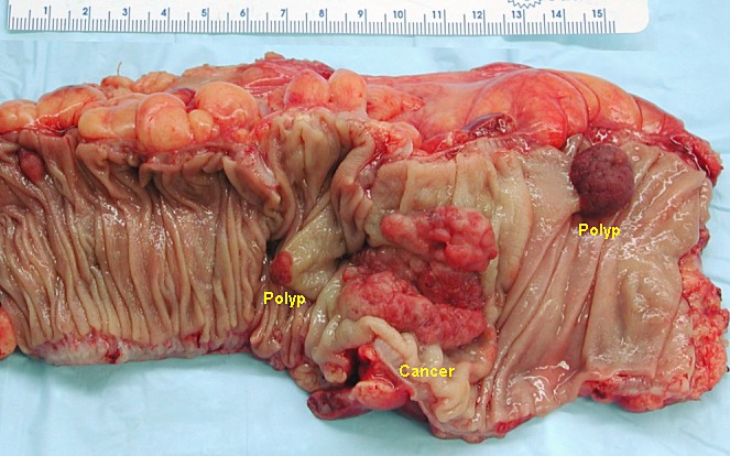 Opened colectomy specimen containing colorectal carcinoma and adenomatous polyps