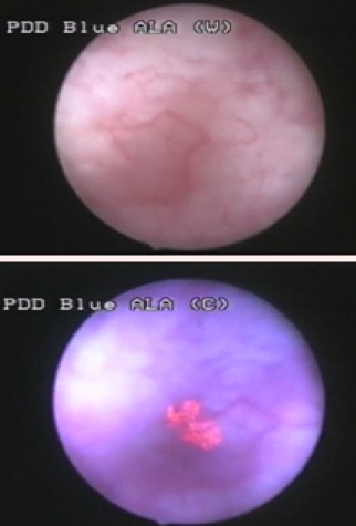 Blue-light cystoscopy bladder CIS