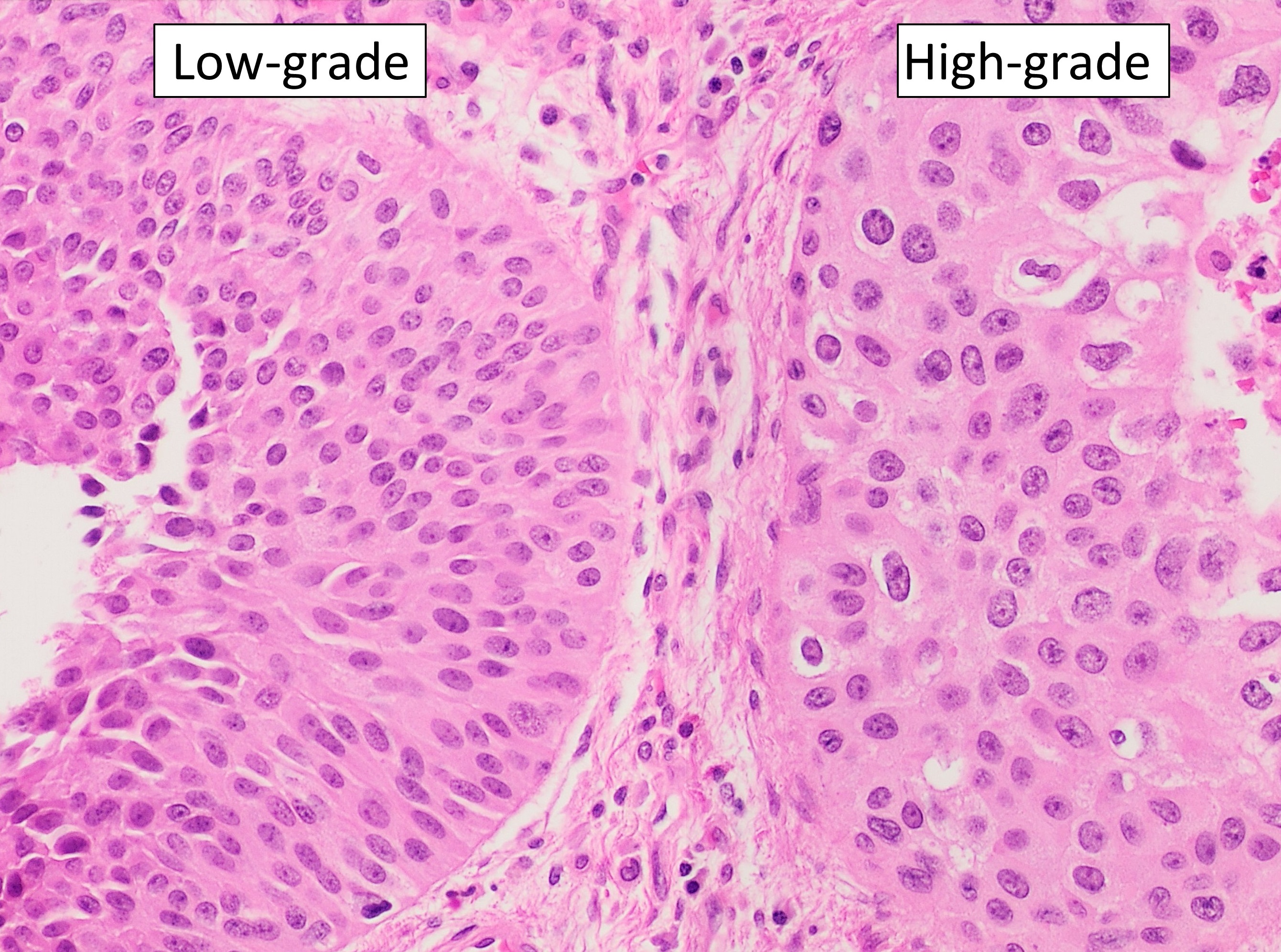 Bladder urothelial carcinoma histology