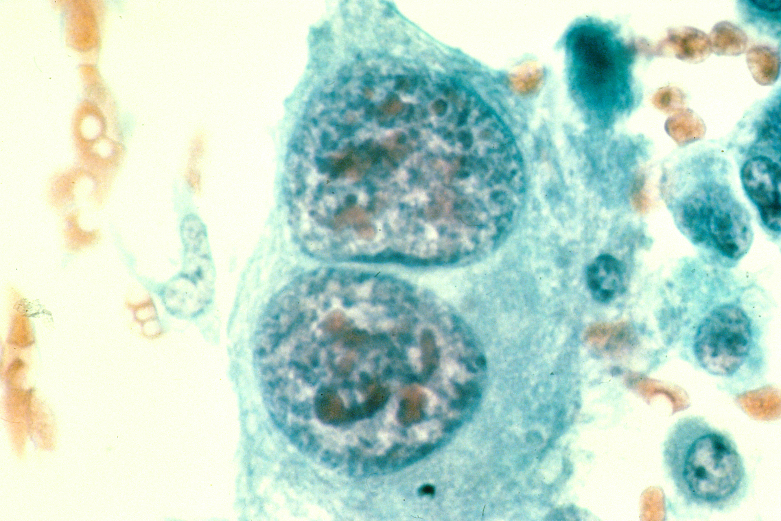 Osteosarcoma cytology