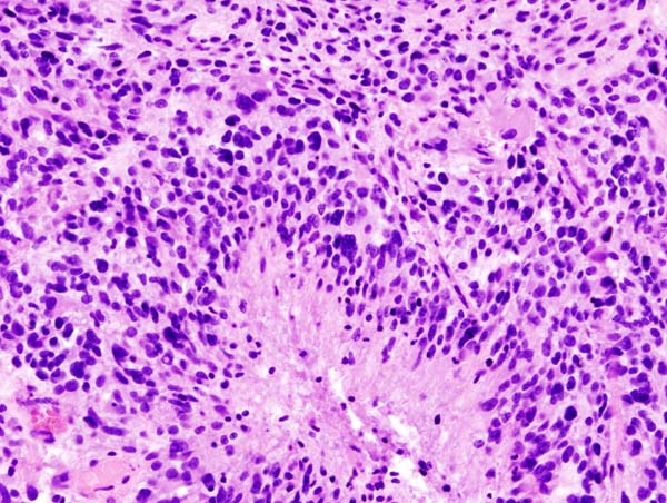 Glioblastoma histology.