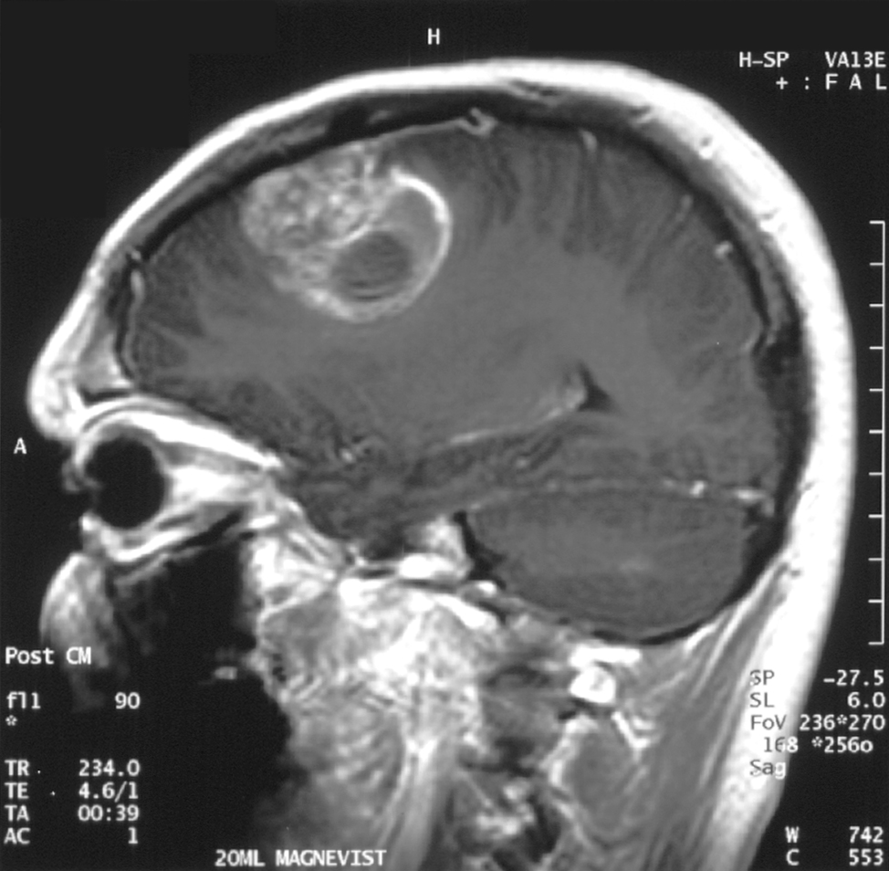 MRI image of glioblastoma