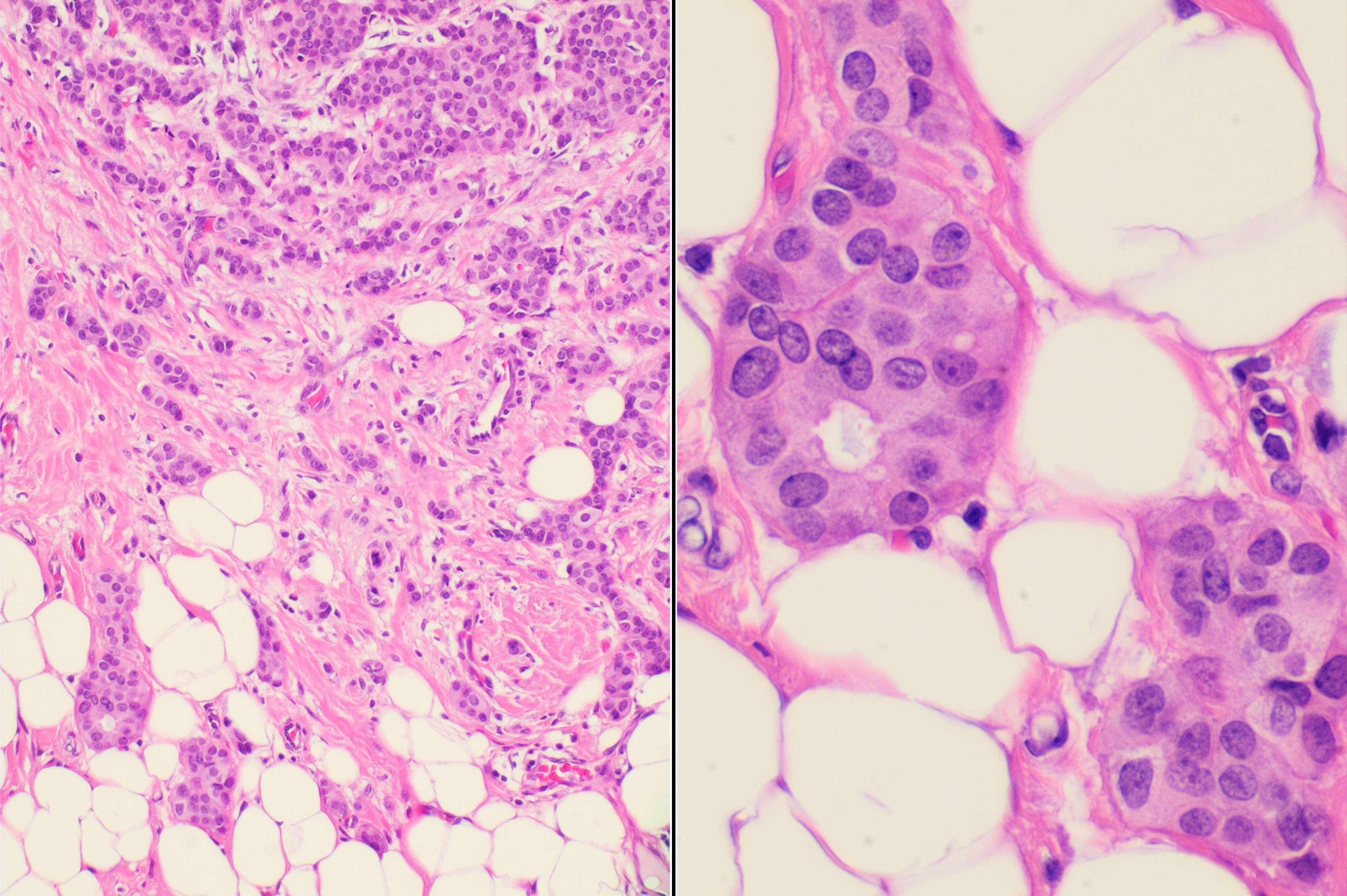 Breast invasive ductal carcinoma histology