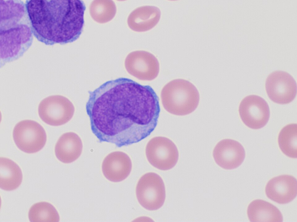 Leukemia laboratory visual