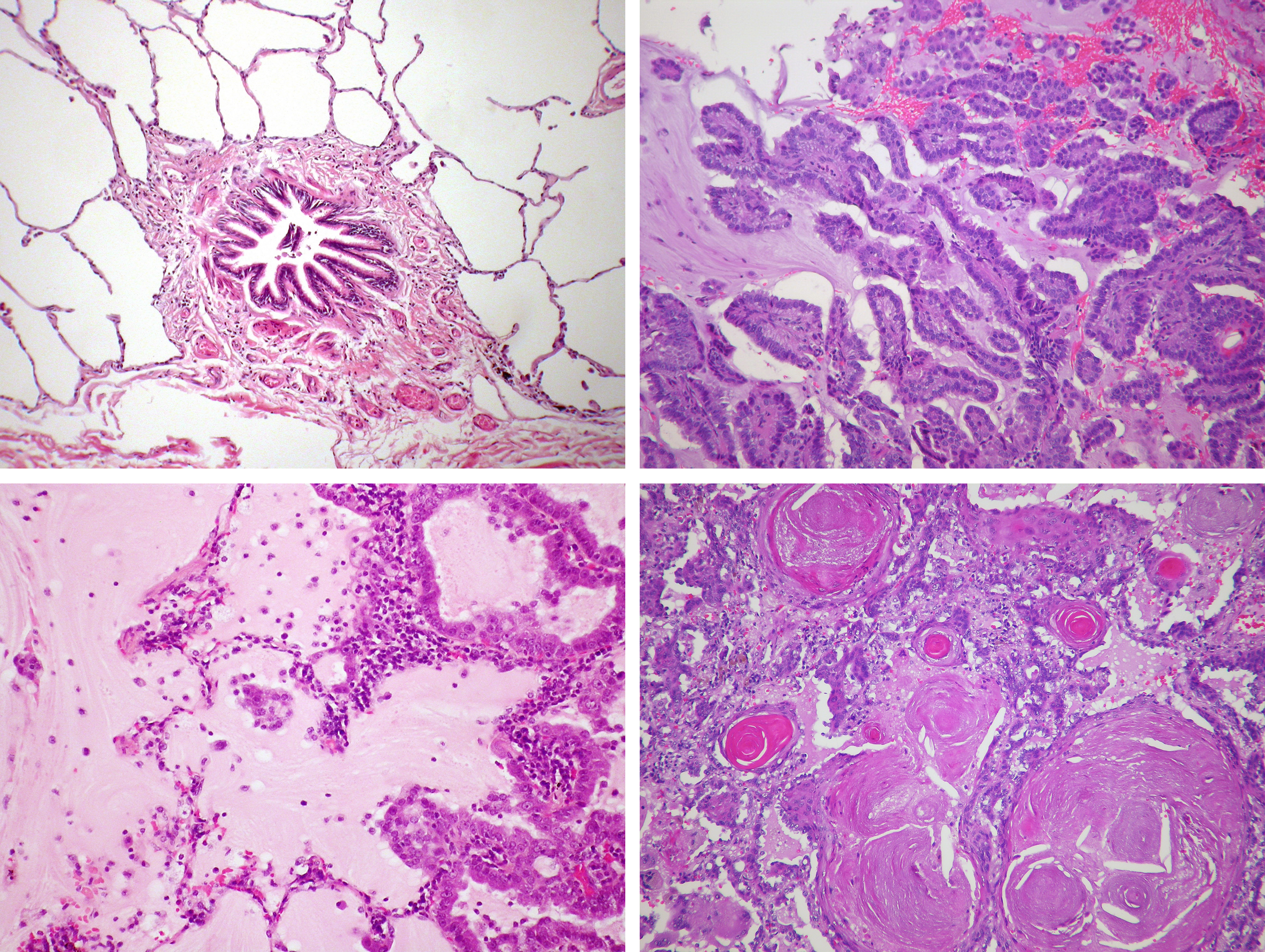 Lung cancer histology collection.