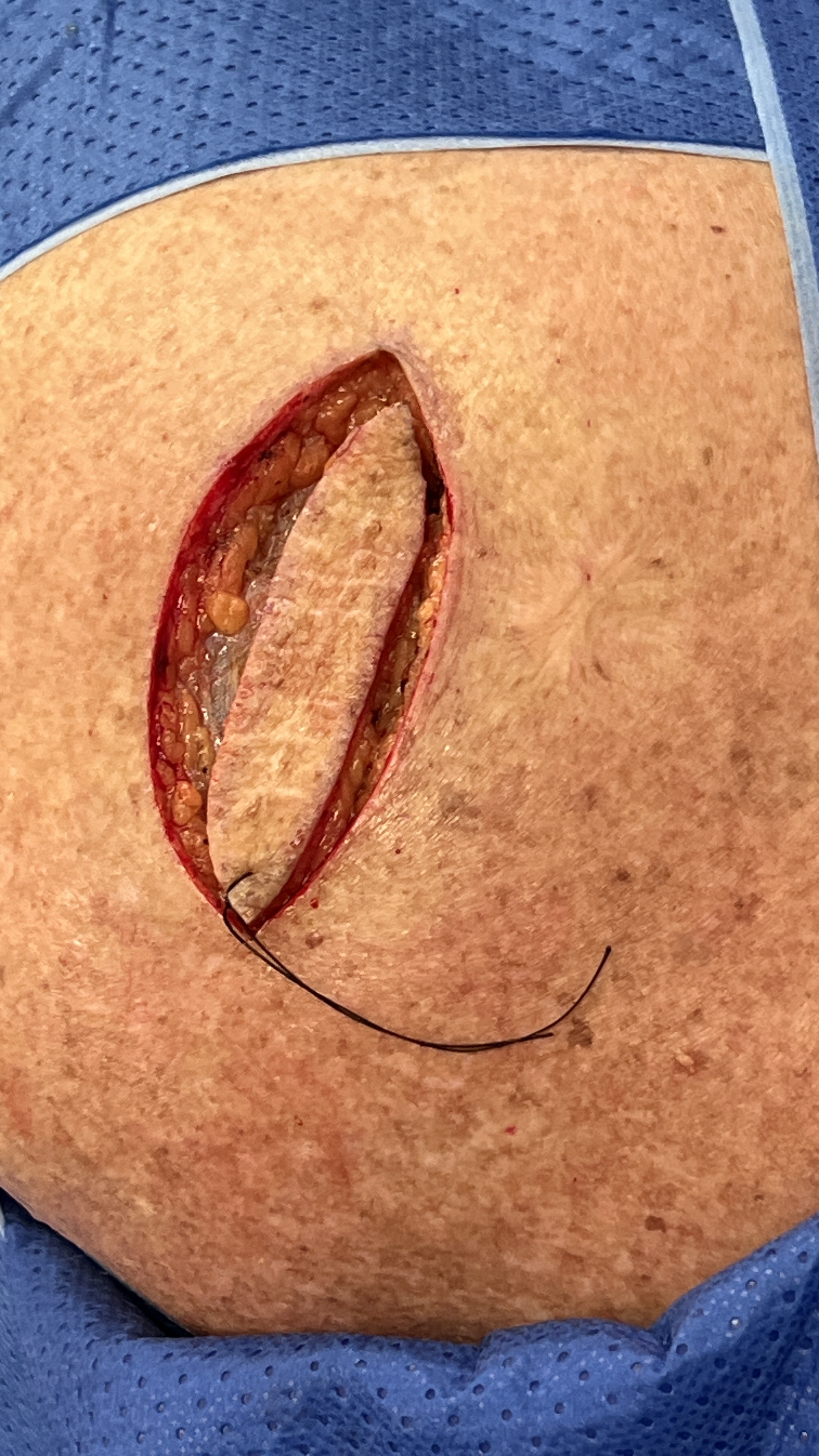 Skin excision closure