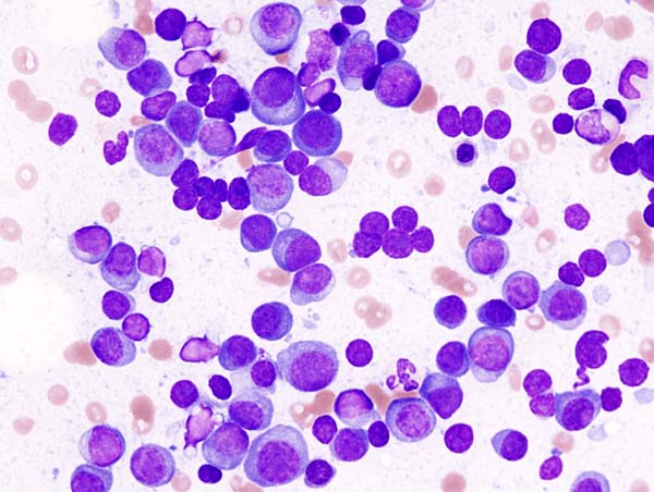Bone marrow smear