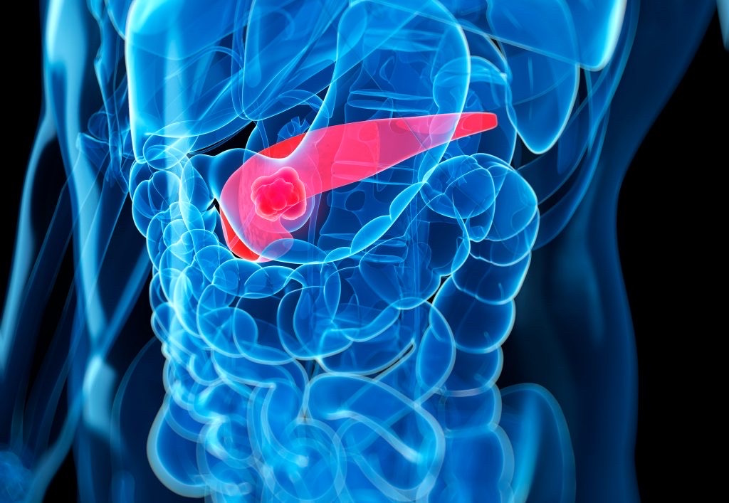 Pancreatic cancer medical illustration