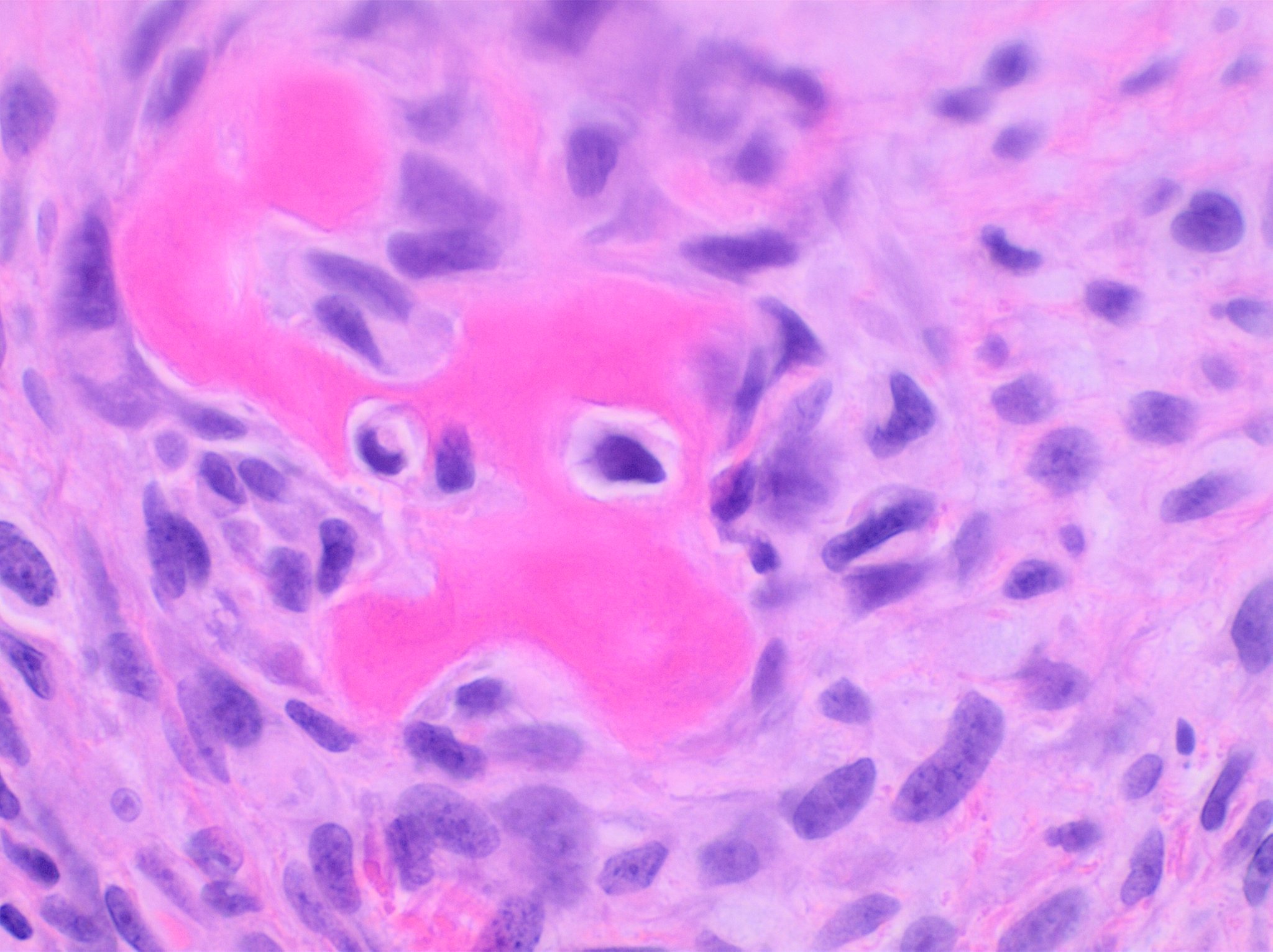 Sarcoma histology example
