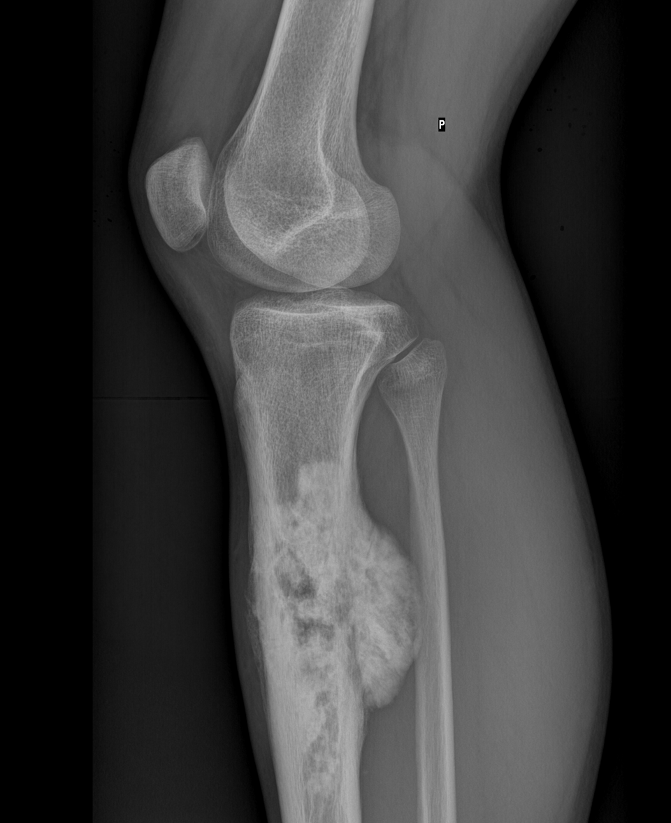 Bone tumor visual