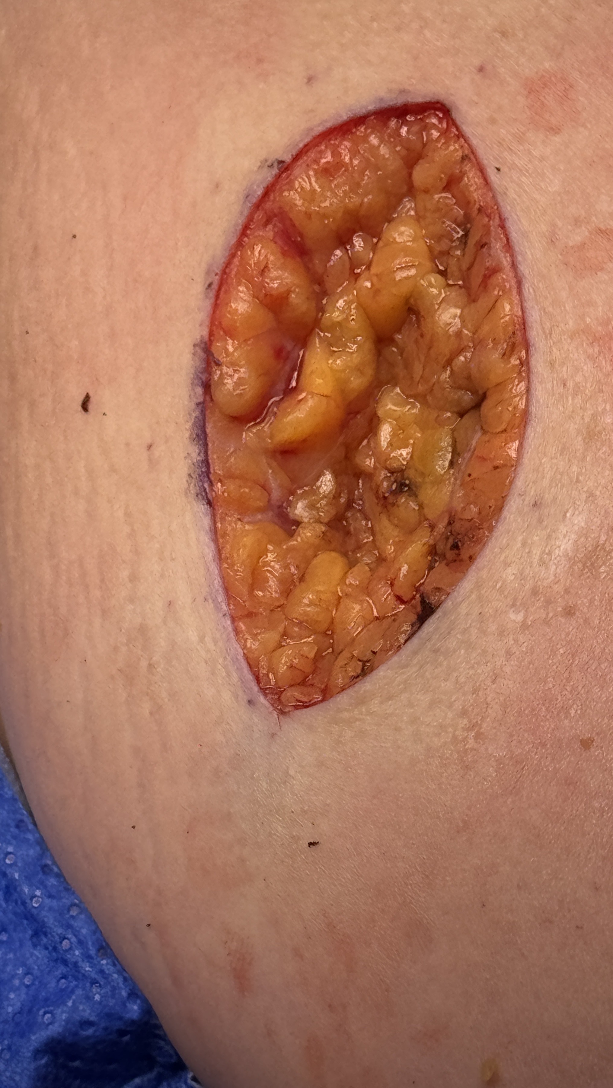 Open skin cancer excision