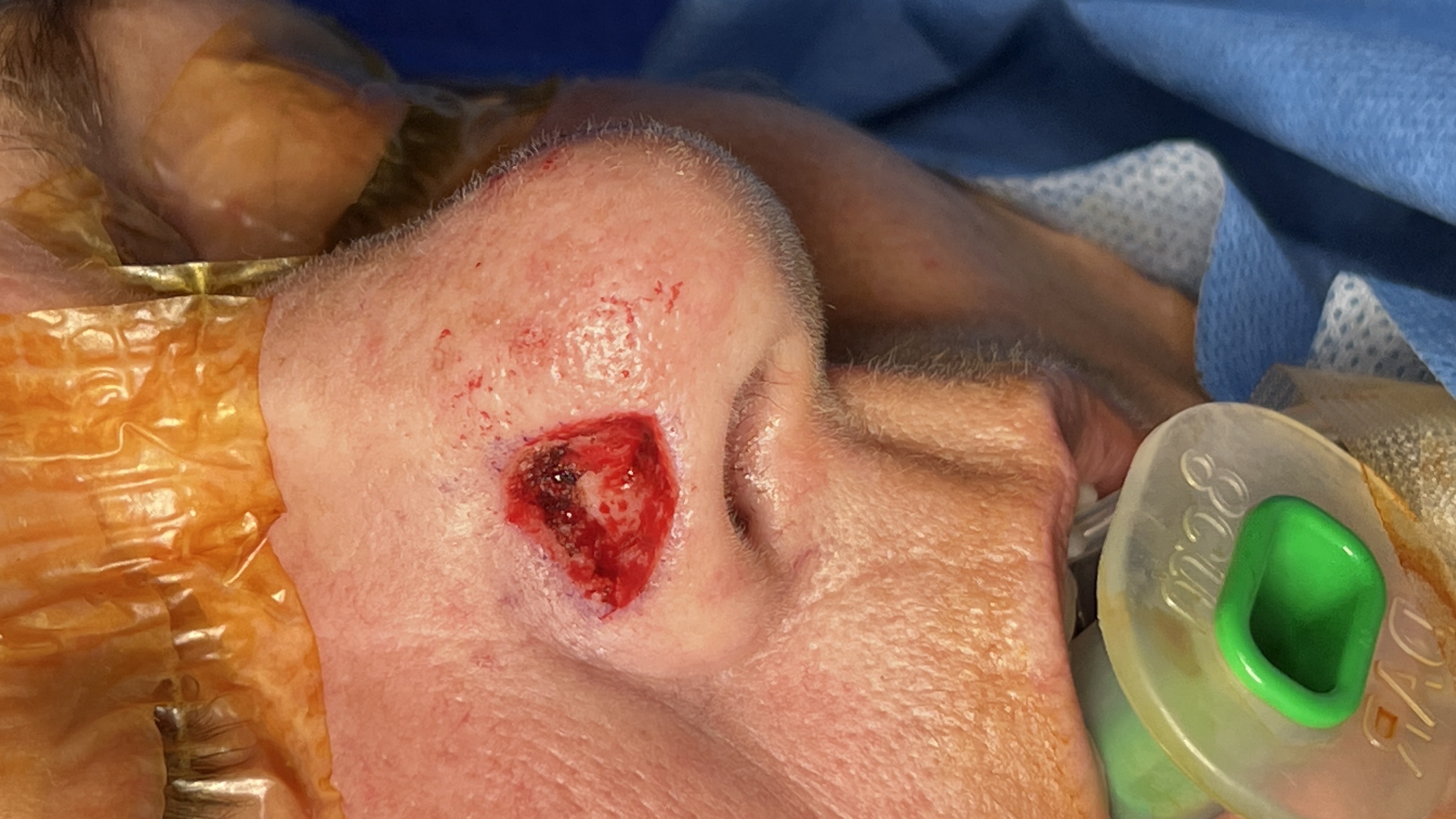 Large skin cancer excision defect