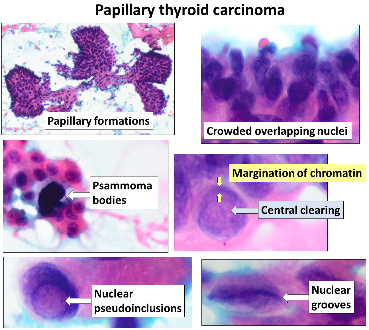 Papillary thyroid carcinoma cytology.